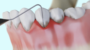 Parodontite et formation de la poche parodontale
